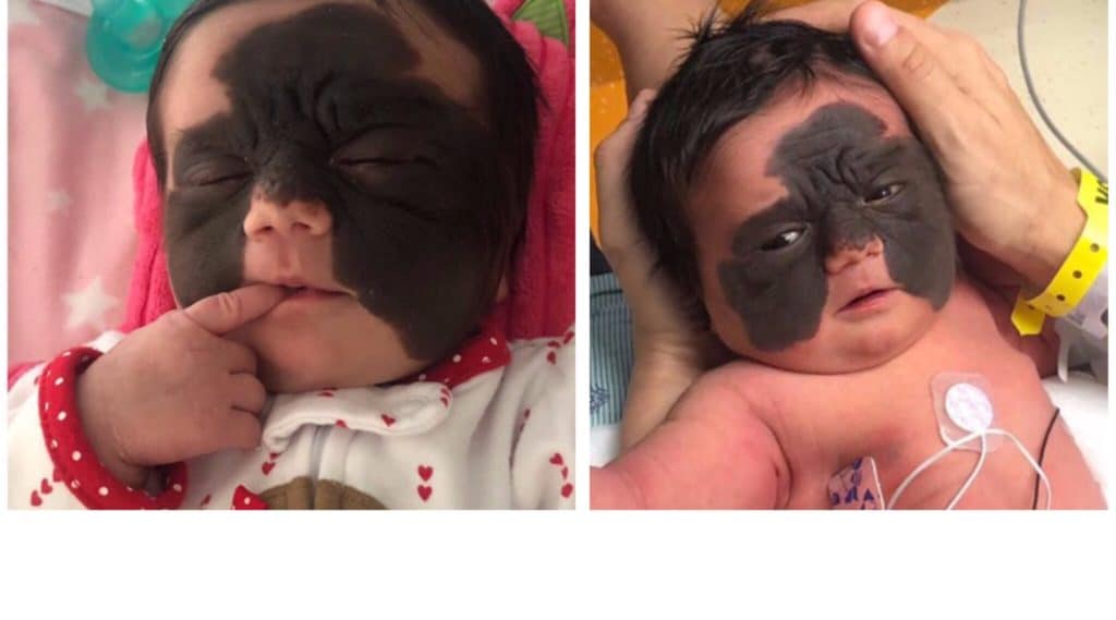 La bambina nata con una macchia rara sul viso conquista i cuori di tutto il mondo