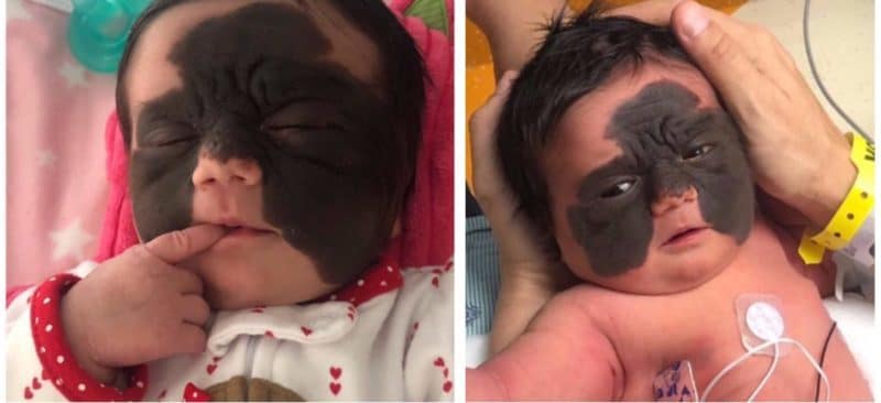 La bambina nata con una macchia rara sul viso conquista i cuori di tutto il mondo