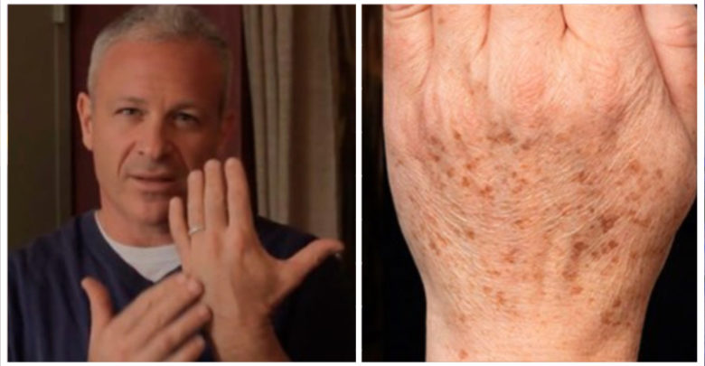 Rimedio naturale di un noto dermatologo
