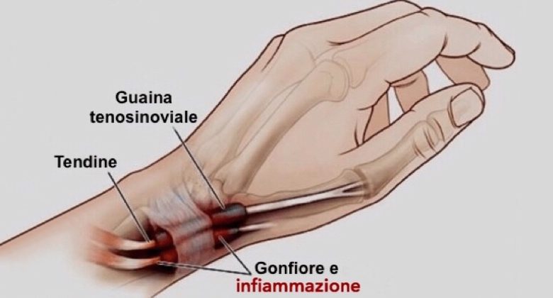 Tenosinovite, le cause, i sintomi e i trattamenti