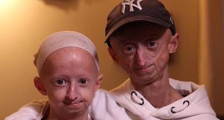 progeria