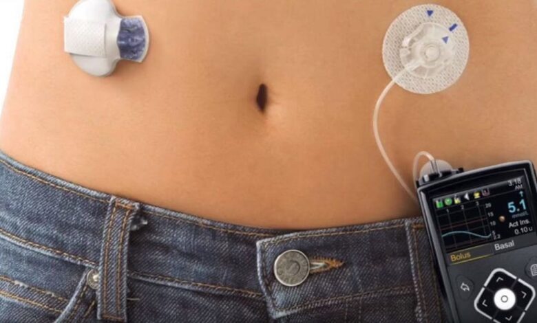 Il primo pancreas artificiale
