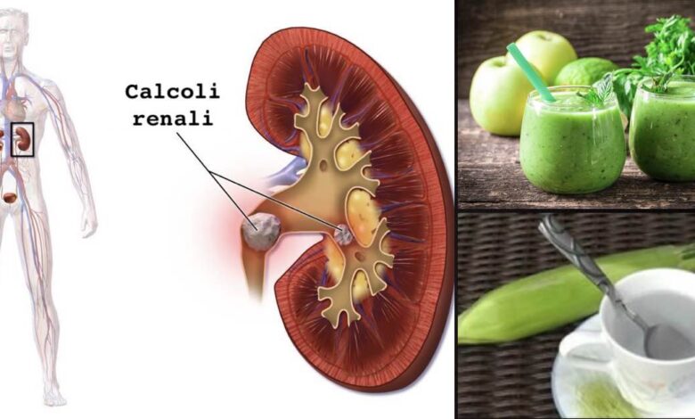 Calcoli renali