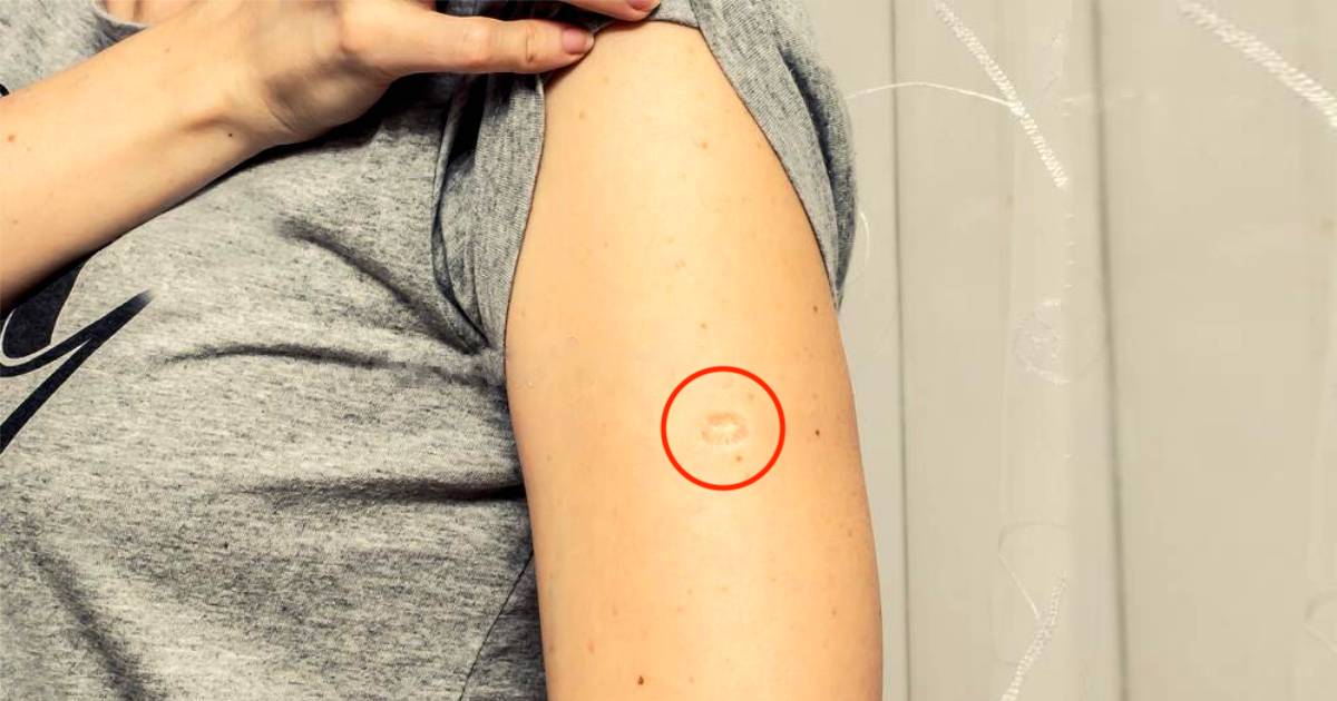 Perché molte persone hanno una piccola cicatrice sul braccio sinistro?
