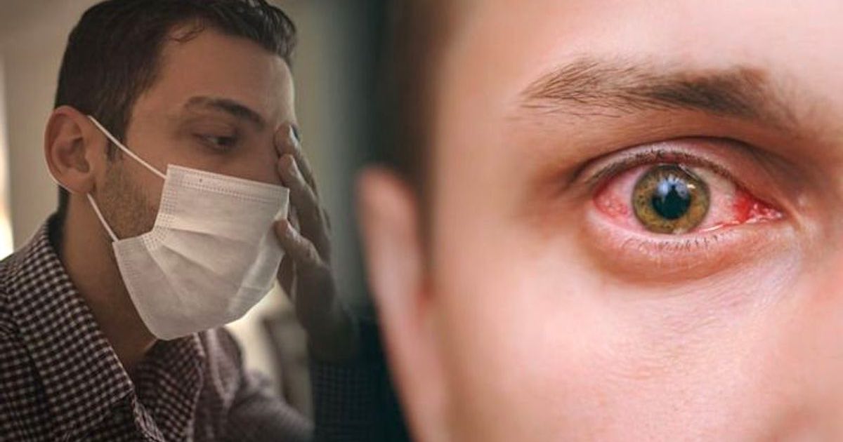 gli occhi rossi possono essere un sintomo del nuovo Coronavirus